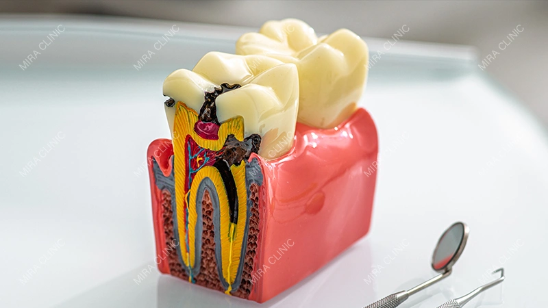 Cracked Tooth